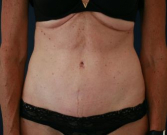 Feel Beautiful - Type 2 Tummy Tuck - After Photo